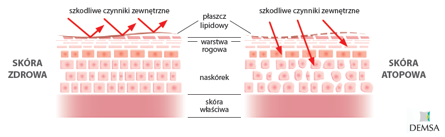 skóra zdrowa i atopowa