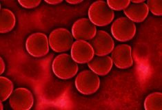 hemofilia objawia się wewnętrznymi wylewami krwi
