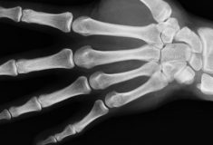 osteoporoza